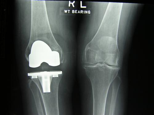 Osteoarthritic Knee Treatment Options List