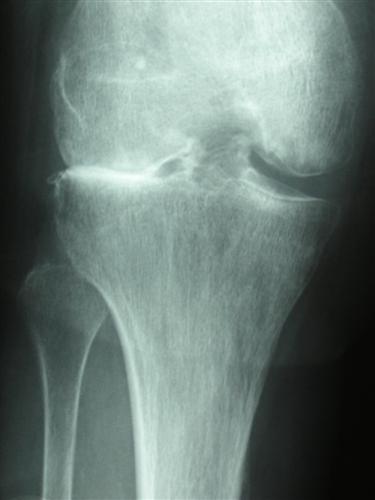 Osteoarthritic Knee Treatment Options List