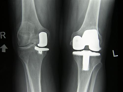 Osteoarthritic Knee Treatment Options List